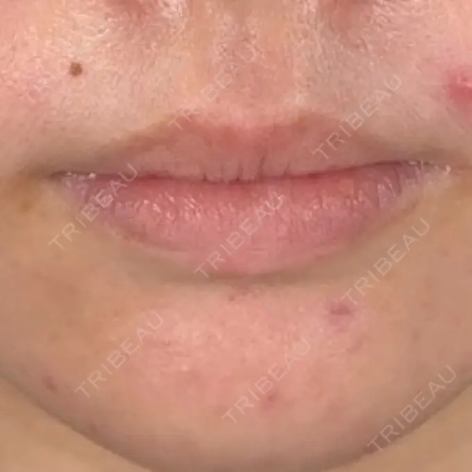 ヒアルロン酸注入（唇） アリエル美容クリニック 横浜院 BEFORE メイン用