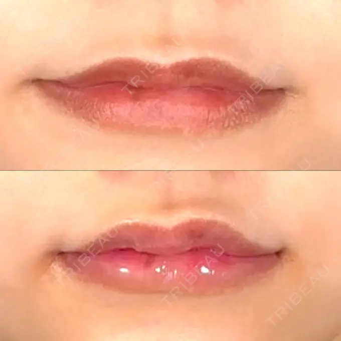 ヒアルロン酸注入（涙袋） / ヒアルロン酸注入（唇） アリエル美容クリニック 横浜院 BEFORE メイン用