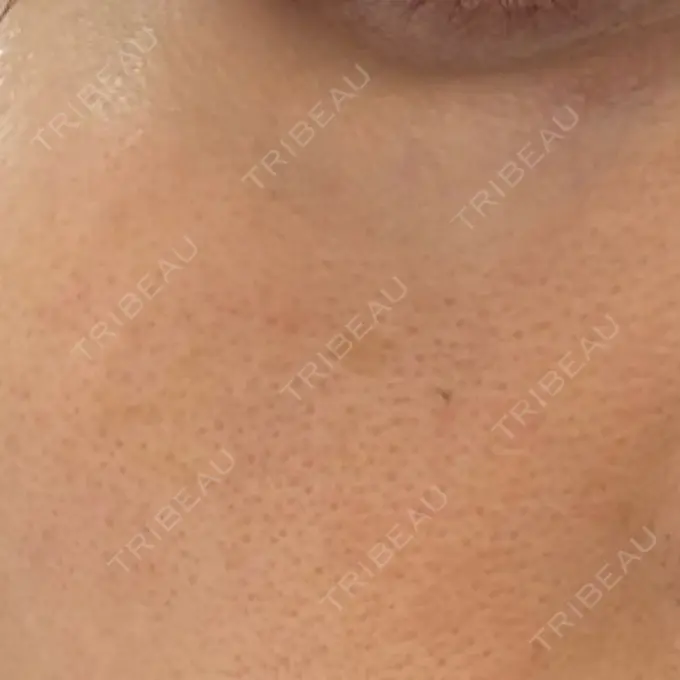 リジュラン 湘南美容クリニック 広島院 BEFORE メイン用