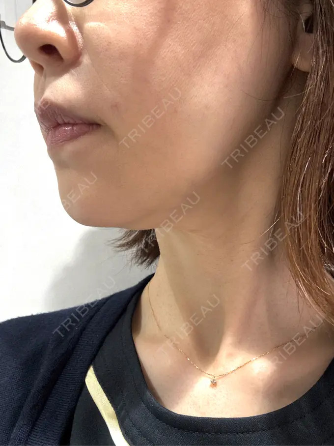 ハイフ（顔） 東京美容外科 福岡院 BEFORE メイン用