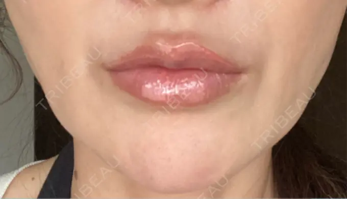 切開リフト GRACY TOKYO CLINIC【グレイシートウキョウクリニック】 BEFORE メイン用