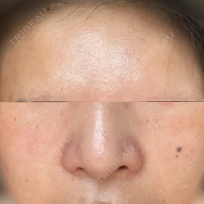 マイクロボトックス 東京シルククリニック 新宿院 BEFORE メイン用