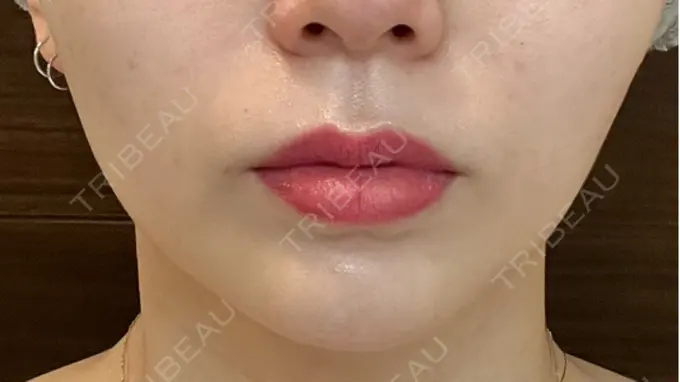 ボトックス（口角） ルラ美容クリニック 広島院 BEFORE メイン用