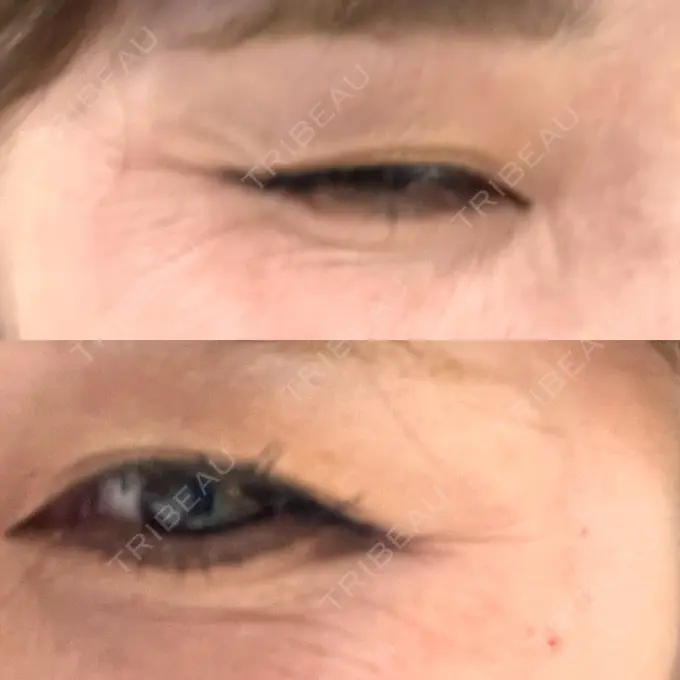 ボトックス（エラ・小顔） / ボトックス（目尻） TCB東京中央美容外科 水戸院 BEFORE メイン用