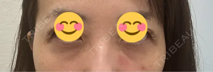 肌育注射（ジュベルックなど） / その他（肌） ゆきスキンクリニック 東池袋 BEFORE メイン用