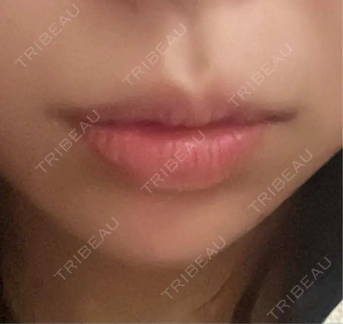 口唇縮小術 B-LINE CLINIC 池袋院 BEFORE メイン用