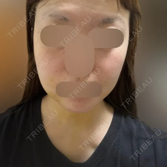 インディバ（顔） Casa de GRACIA GINZA 【カーサデグラシアギンザ】 BEFORE メイン用