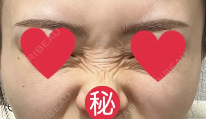 ボトックス（バニーライン） 共立美容外科 広島院 BEFORE メイン用