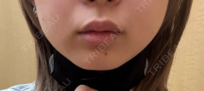 その他（輪郭） さっぽろ美容クリニック BEFORE メイン用