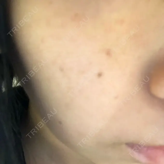 水光注射（ハリ・美肌） Wクリニック 心斎橋院 BEFORE メイン用