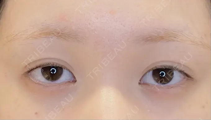 目尻切開 / タレ目形成・グラマラスライン（埋没） LOUIS CLINIC 二子玉川院【ルイクリニック】 BEFORE メイン用