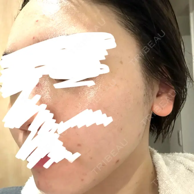 イオン導入 / 光治療（フォトフェイシャルなど） DAILY SKIN CLINIC 新宿院 BEFORE メイン用