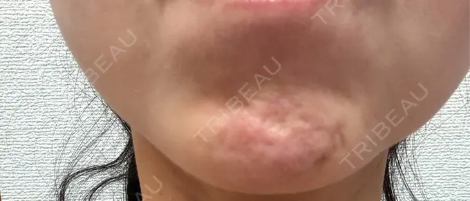 ボトックス（あご） Belle Via Skin Clinic BEFORE メイン用