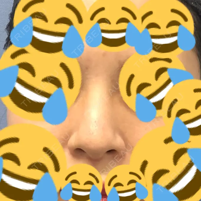 鼻尖形成（切開） / 小鼻縮小（切開） / 軟骨移植 / 骨切幅寄せ / ワシ鼻修正・ハンプ切除 FROM B整形外科 (旧バウム整形外科) BEFORE メイン用