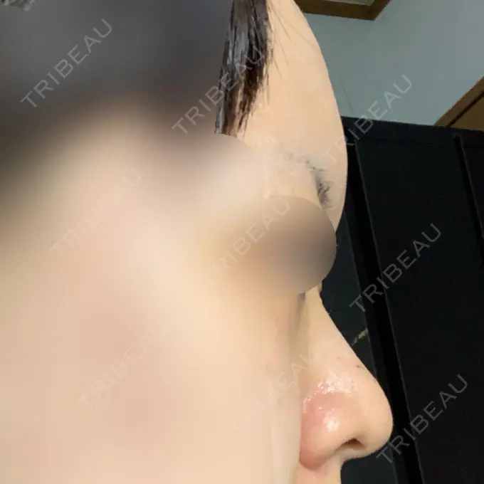 レディエッセ注入（鼻） 東京イセアクリニック BEFORE メイン用