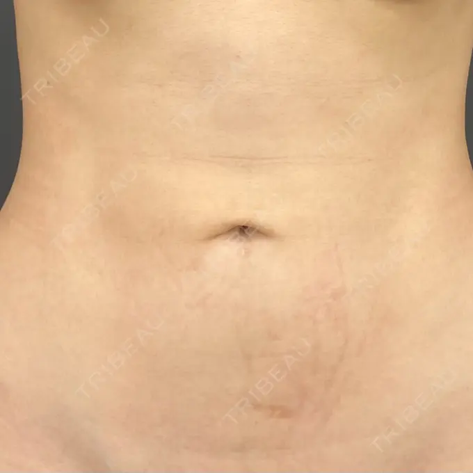 へそ形成 Casa de GRACIA GINZA 【カーサデグラシアギンザ】 BEFORE メイン用