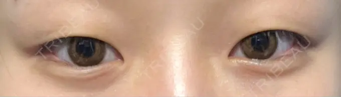 二重埋没 恵聖会クリニック 京橋院 BEFORE メイン用