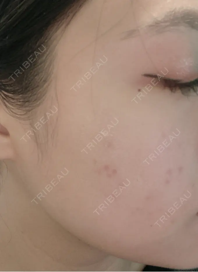 エレクトロポレーション Otus Clinic 【オータスクリニック】 BEFORE メイン用