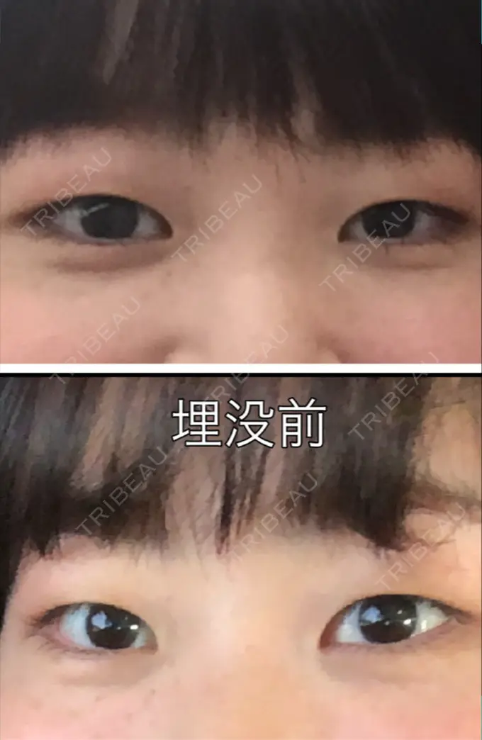 二重埋没 新宿美容外科クリニック 立川院 BEFORE メイン用