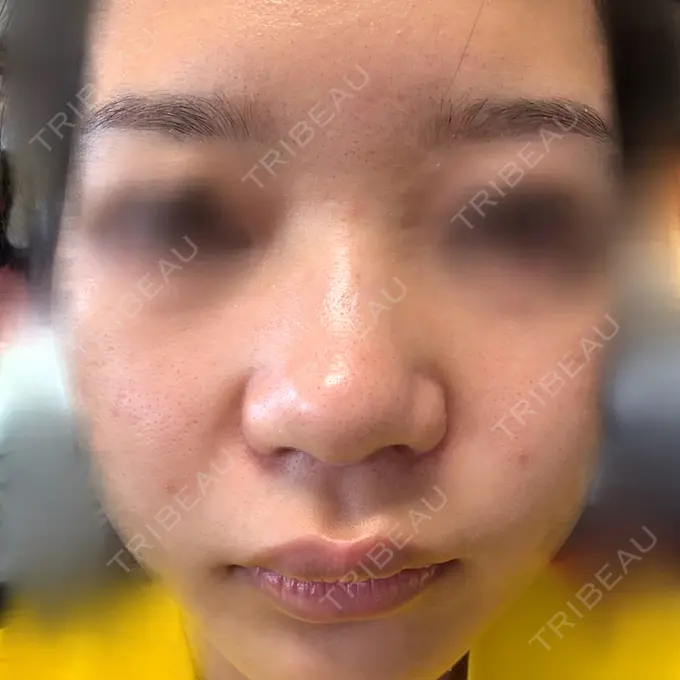 肌育注射（ジュベルックなど） TRUE DESIGN CLINIC BEFORE メイン用