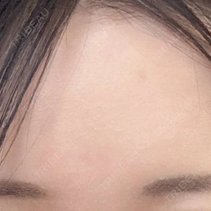 ボトックス（眉間） TCB東京中央美容外科 新宿三丁目院 BEFORE メイン用