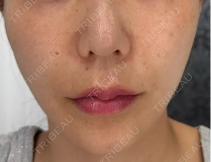 肌育注射（ジュベルックなど） BIANCA銀座 BEFORE メイン用