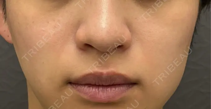 小鼻縮小（切開） 渋谷の森クリニック BEFORE メイン用