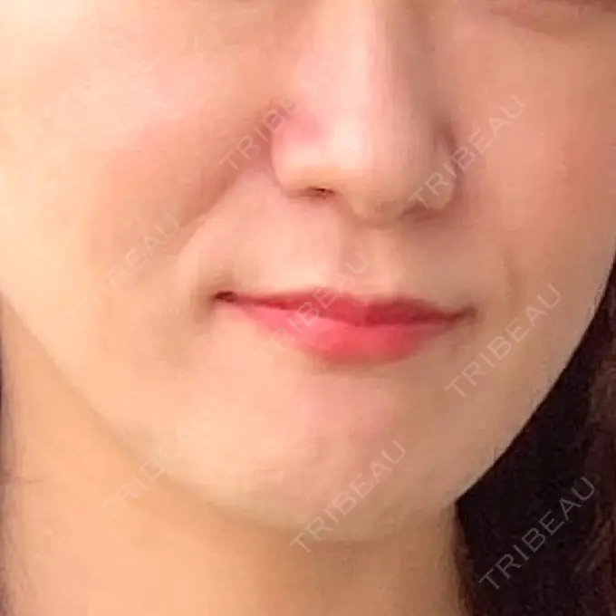 肌育注射（ジュベルックなど） / その他（肌） ゆきスキンクリニック 東池袋 BEFORE メイン用