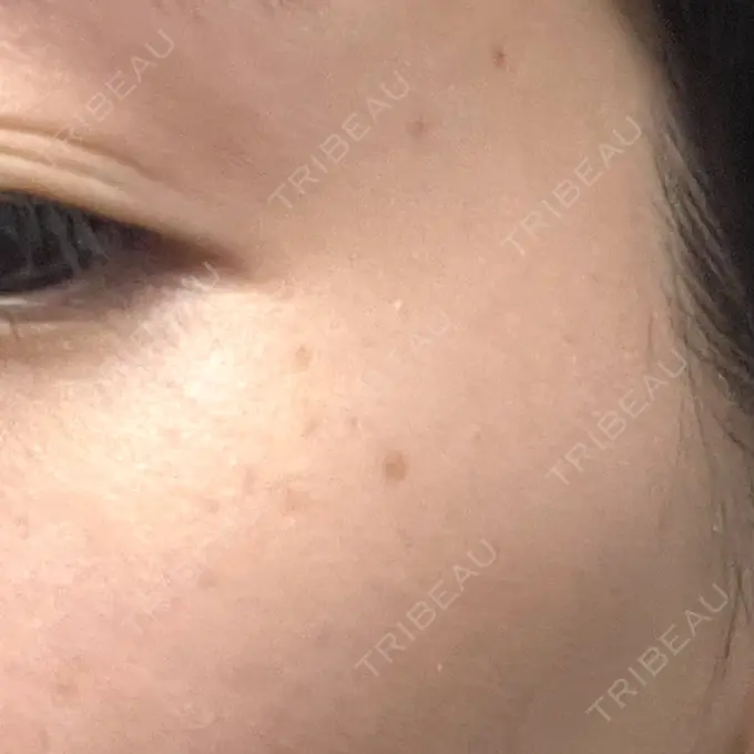 ルメッカ Grias clinic （ジリアスクリニック） BEFORE メイン用