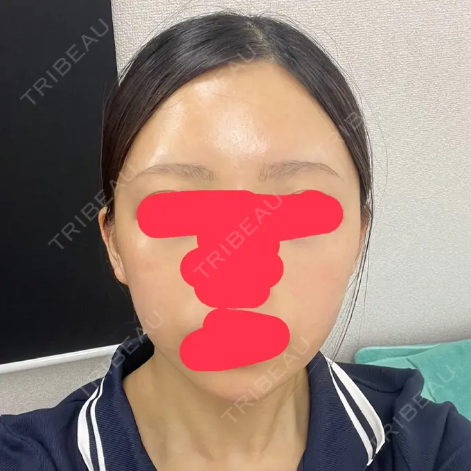 水光注射（ハリ・美肌） / ボトックス（肩） TUNE CLINIC【チューンクリニック】 BEFORE メイン用