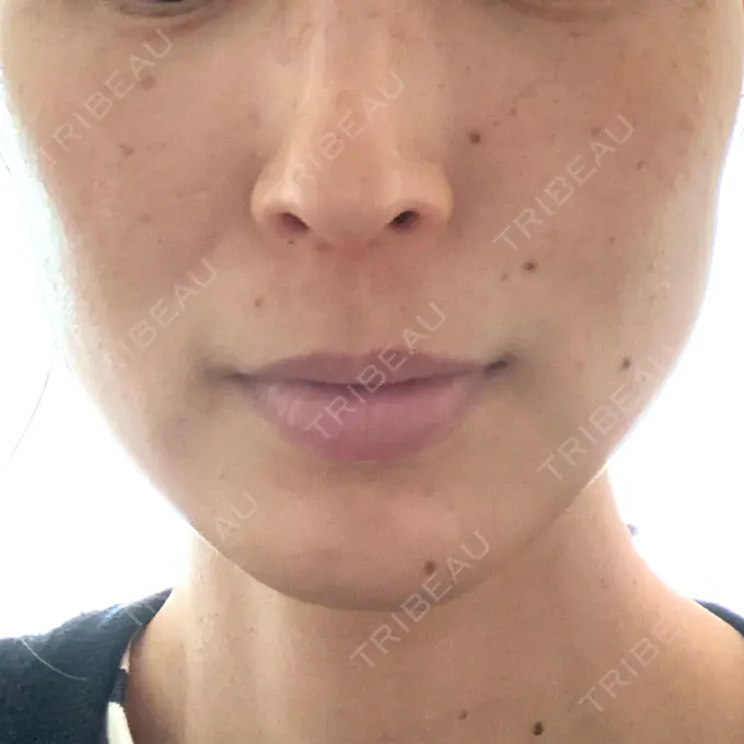 ルメッカ 大美会クリニック 岡山院 BEFORE メイン用