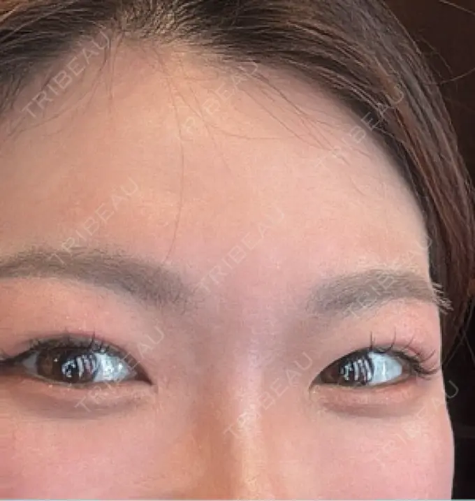 上まぶたの脂肪取り 湘南美容クリニック 大阪四ツ橋院 BEFORE メイン用