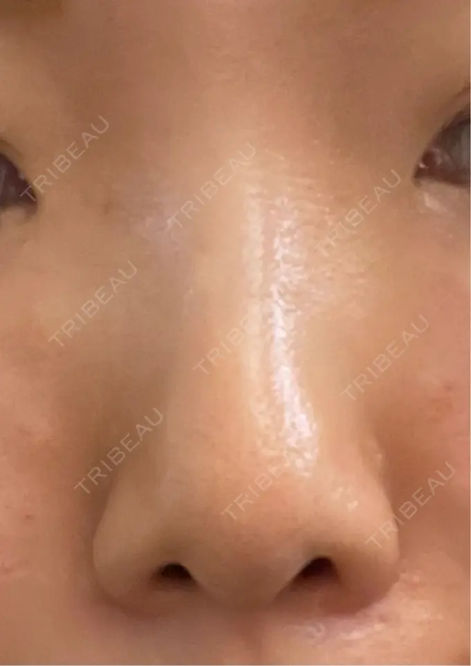 ヒアルロン酸注入（鼻） プライベートスキンクリニック 梅田本院 BEFORE メイン用