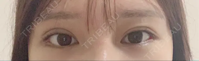 目尻切開 / 目元修正 / 目尻靭帯移動 DIVINE（ディバイン）整形外科 BEFORE メイン用