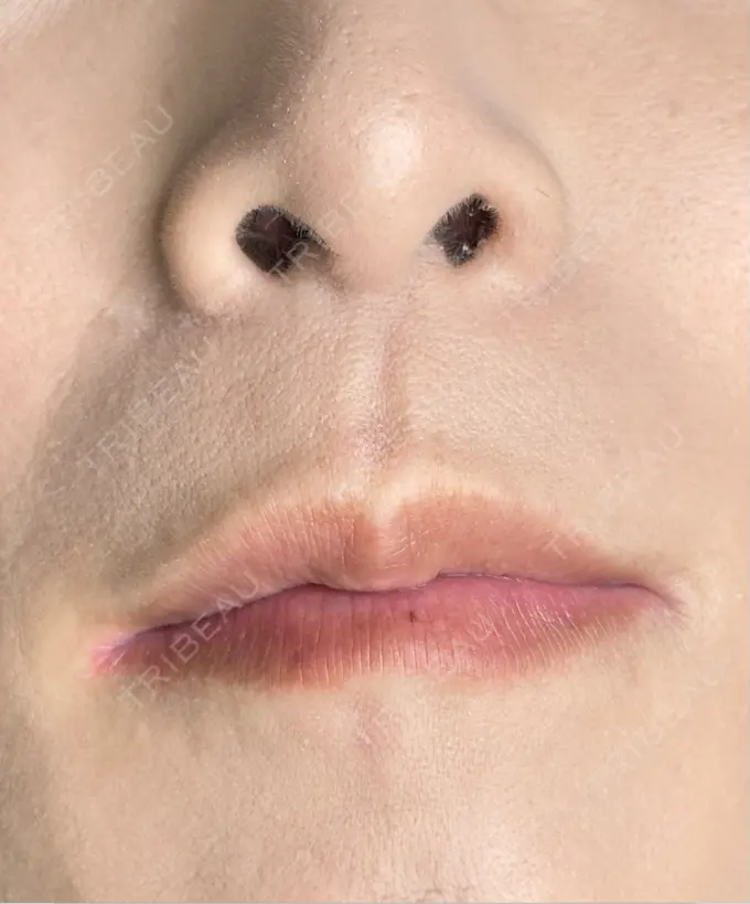 アートメイク（唇） TRUE DESIGN CLINIC BEFORE メイン用