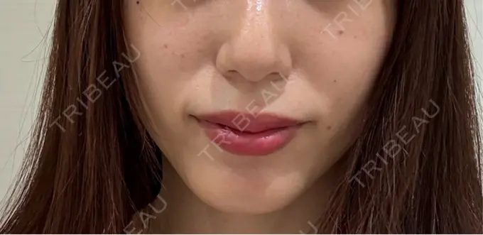 ショッピングリフト BAO CLINIC 梅田院 BEFORE メイン用