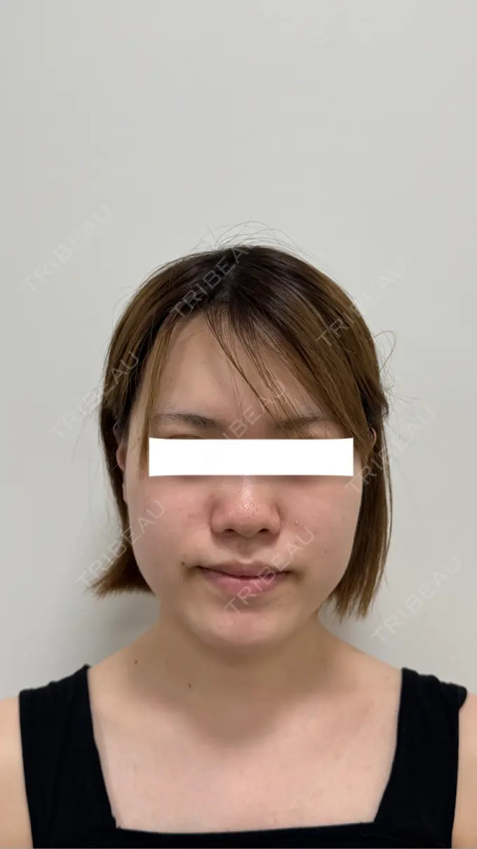 糸リフト / 脂肪吸引（顔） / ジョールファット除去 / 脂肪吸引注射（顔） / ボトックス（エラ・小顔） SEA CLINIC（シークリニック） BEFORE メイン用