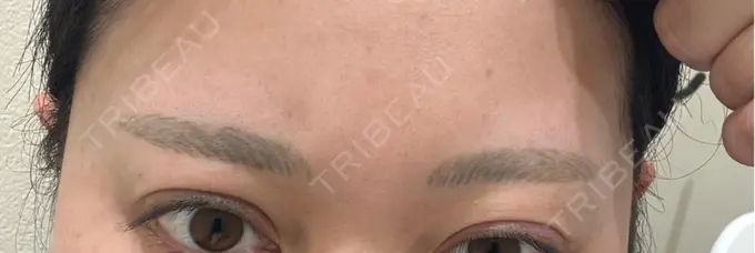 アートメイク除去・修正 ライズワン美容皮膚科クリニック BEFORE メイン用