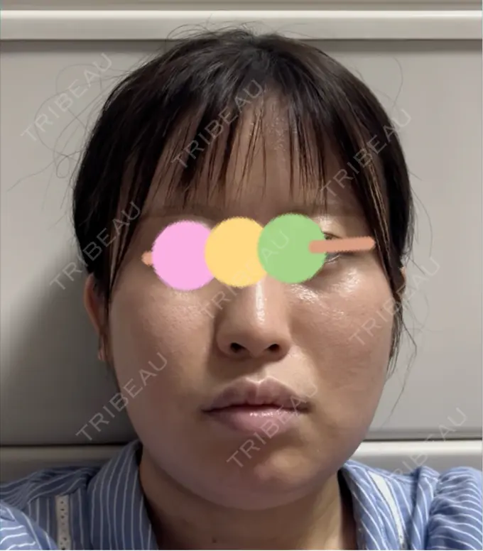 骨切り（あご） / 骨削り（エラ） / ルフォー+ssro（両あご) / その他（輪郭） コントアクリニック 東京 BEFORE メイン用