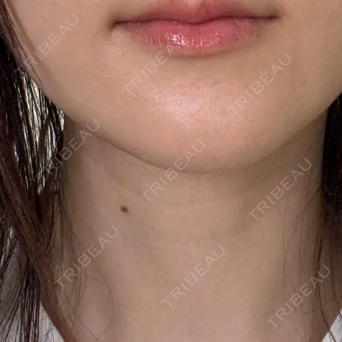 ほくろ・いぼ除去レーザー（肌） PureMe Skin Clinic（ピュアミースキンクリニック麻布） BEFORE メイン用