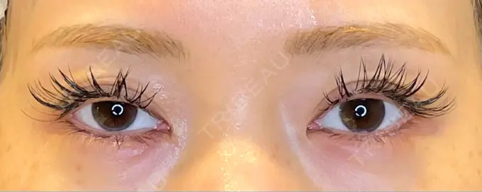 目尻切開 / タレ目形成・グラマラスライン（埋没） LOUIS CLINIC 二子玉川院【ルイクリニック】 BEFORE メイン用