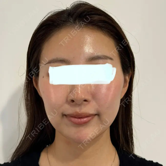 糸リフト / 脂肪吸引（顔） / 額を丸く / 脂肪注入（額） / ジョールファット除去 / 脂肪吸引注射（顔） / 脂肪注入（輪郭） / 美容点滴・美容注射（疲労回復） / その他 SEA CLINIC（シークリニック） BEFORE メイン用