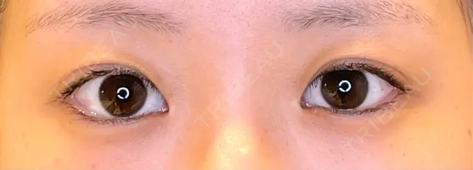 目尻切開 / タレ目形成・グラマラスライン（埋没） LOUIS CLINIC 二子玉川院【ルイクリニック】 BEFORE メイン用