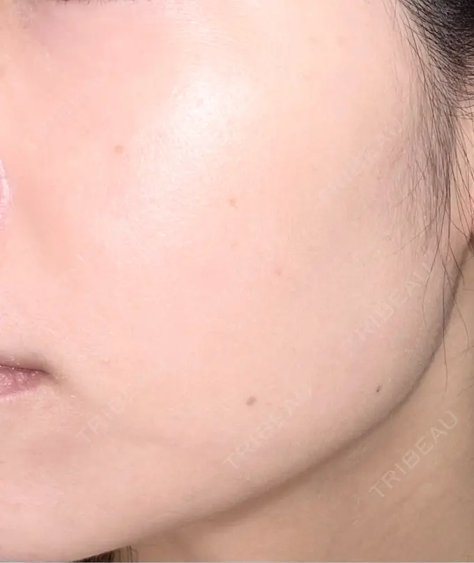 美肌レーザー / 美白レーザー / YAGレーザー / レーザーフェイシャル / 赤み除去レーザー AI Beauty Clinic （エーアイ美容クリニック） BEFORE メイン用