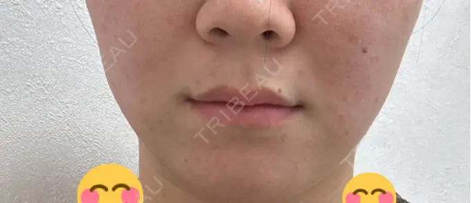 ボトックス（エラ・小顔） アリエル美容クリニック 横浜院 BEFORE メイン用