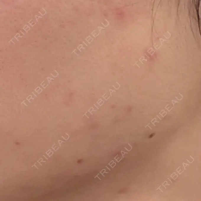 イオン導入 城本クリニック 大宮院 BEFORE メイン用