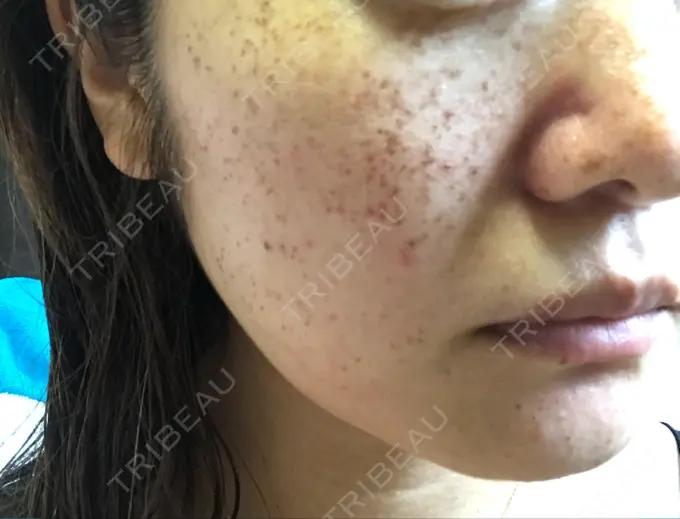 プラセンタ注射 / フォトRF / フォトシルクプラス 品川スキンクリニック品川院 BEFORE メイン用