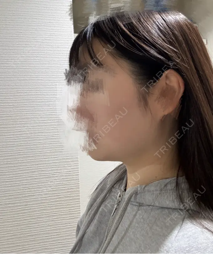 脂肪吸引（顔） THE CLINIC（ザ・クリニック） 福岡院 BEFORE メイン用