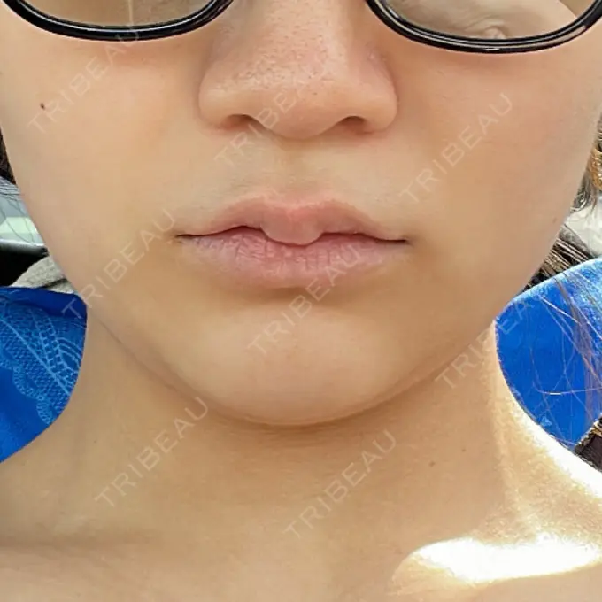 RF（高周波）たるみ治療 BITO BEAUTY CLINIC BEFORE メイン用