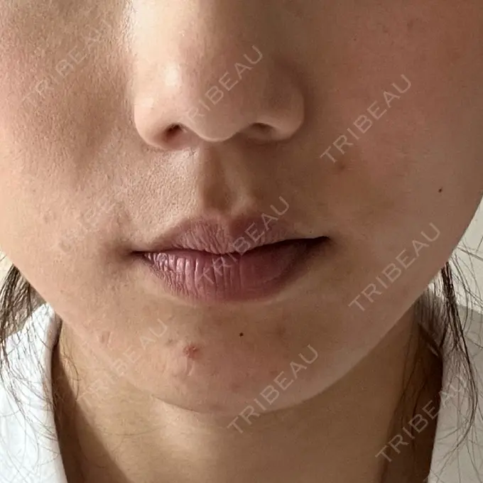 ピーリング（ニキビ・毛穴） / エレクトロポレーション / 毛穴洗浄（ハイドラフェイシャルなど） Casa de GRACIA GINZA 【カーサデグラシアギンザ】 BEFORE メイン用